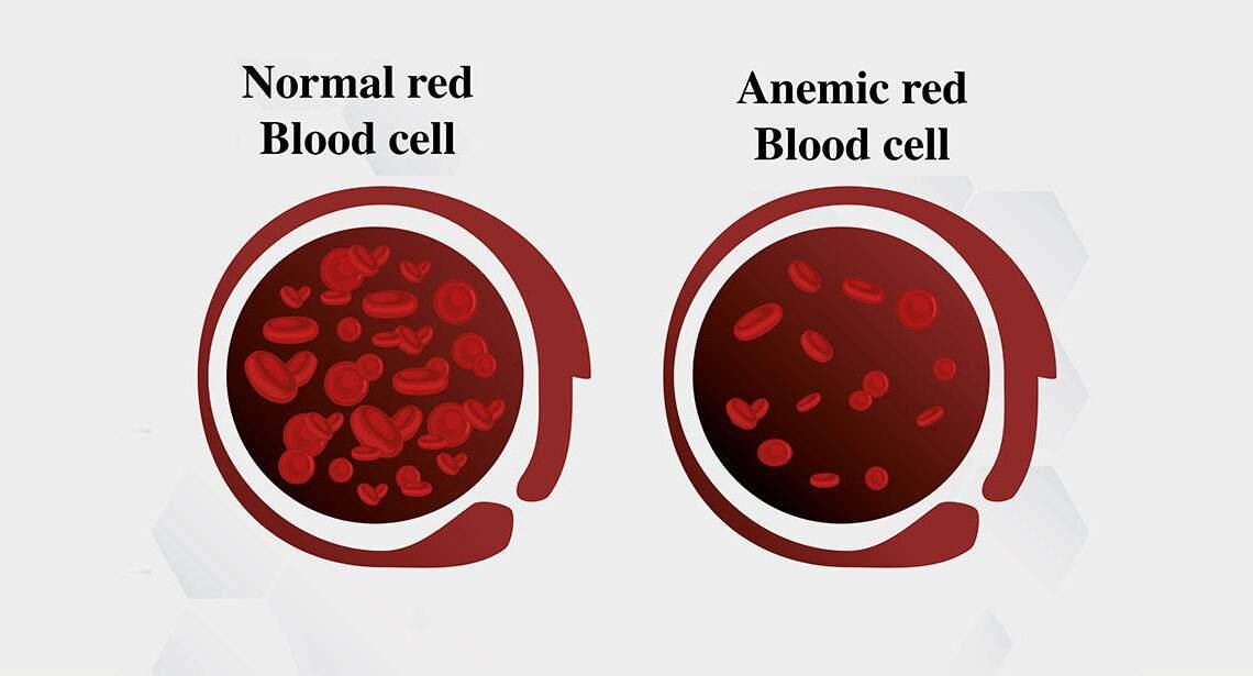 Anemia What It Is Causes And How To Treat It Healthiness360 1619