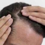 What are Alopecia and its causes.